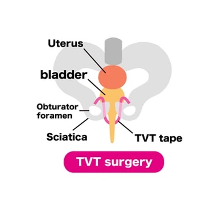 Top TOT TVT Doctors Meerut