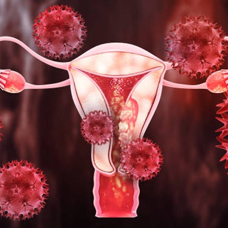 UTIs Symptoms