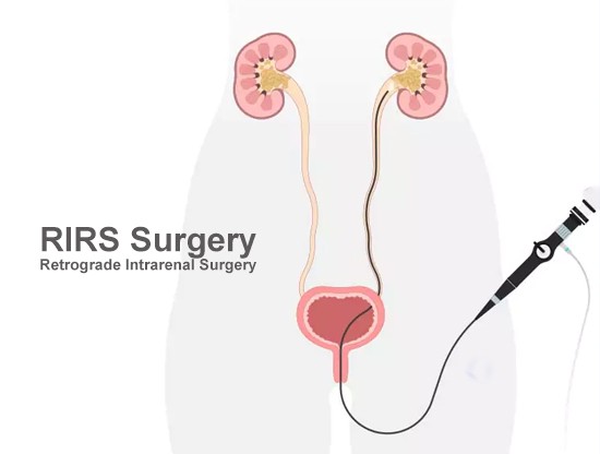 Best RIRS Surgery in Meerut