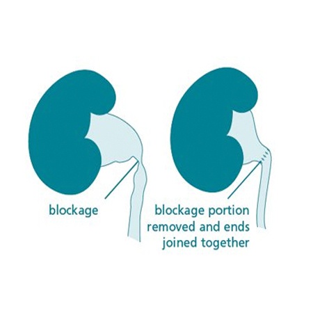 Laparoscopic Pyeloplasty Recovery Specialists Meerut
