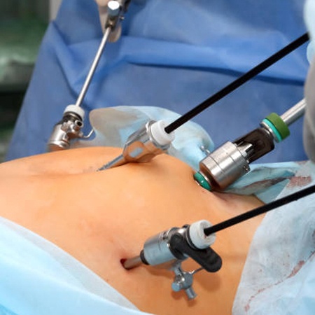 Best Urologist for Laparoscopic Nephrectomy Surgery Meerut