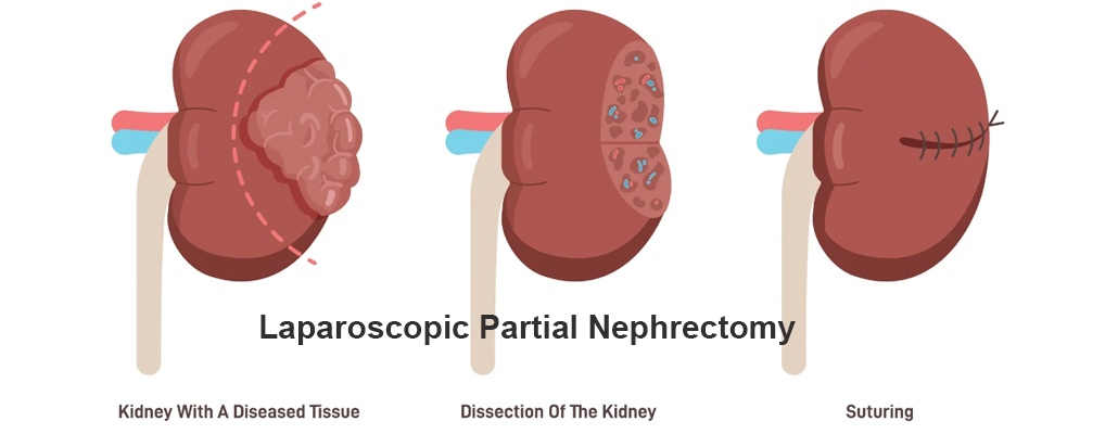 Best Laparoscopic Partial Nephrectomy Surgery Meerut