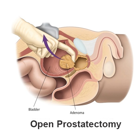 Expert Open Prostatectomy Procedure Meerut