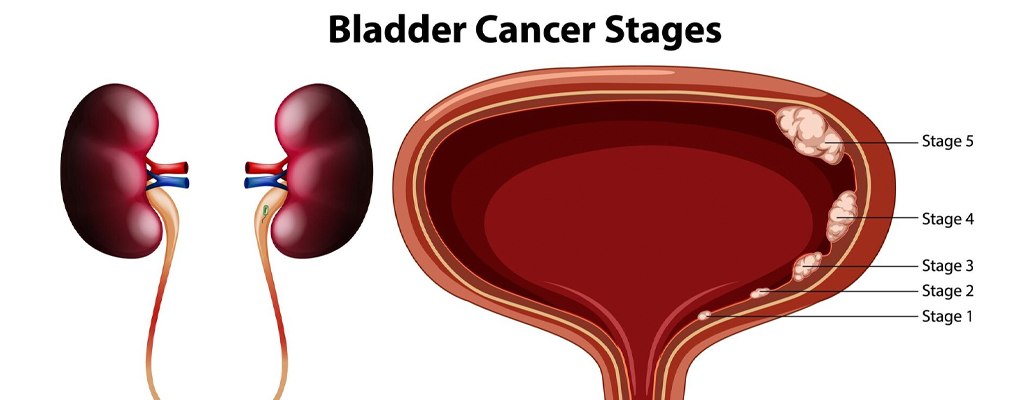 Best TURBT Surgery Meerut