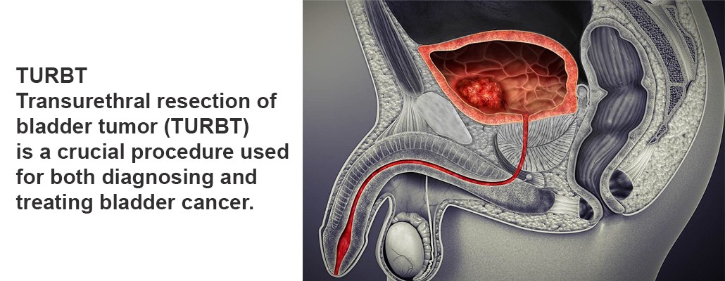 Expert TURBT Procedure Meerut