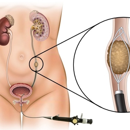 Urologist for Ureteroscopy (URS) Surgery Meerut